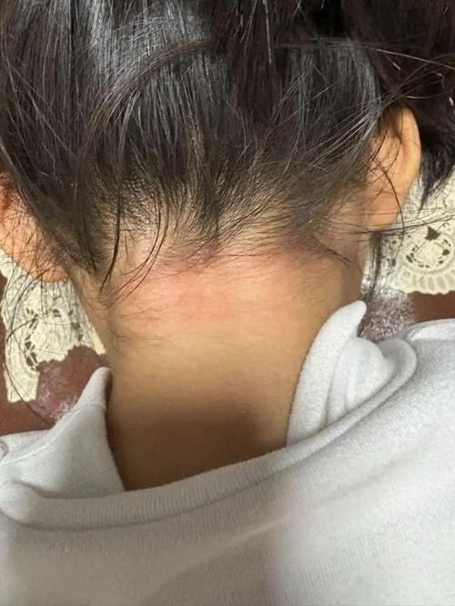 新澳正版资料大全免費和脖子被扎多根烧烤签与被烧烤签子扎出血了